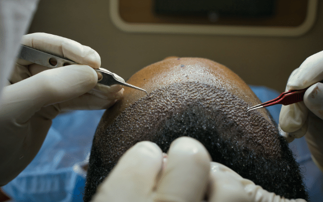 FUE- Metro hair transplant